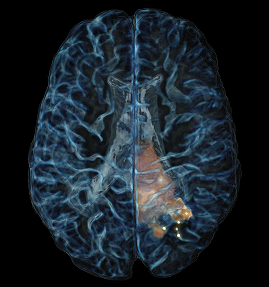 3D brain image from McGill and The Neuro